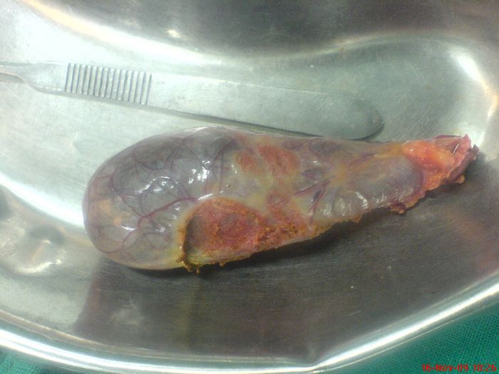 Specimen of Gallbladder After Laparascopic Cholecystectomy