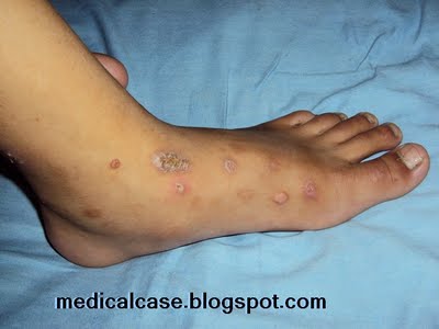 heat rash on legs pictures. Local: Rash in leg: Picture
