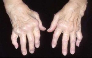 Hand Deformity in RA