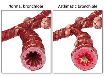Change in bronchi: Asthma