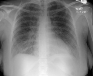 non cardiogenic pulmonary edema 