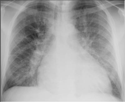 Chest X-ray findings: