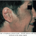 Porphyria: A true story of Vampire?