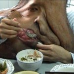Case of Tumorman-Neurofibromatosis, von Recklinghausen's disease