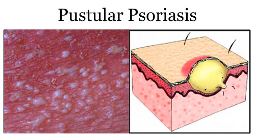 psoriasis skin disease