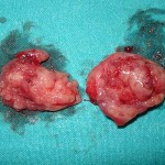 Tonsillectomy Procedure and Indications: Video