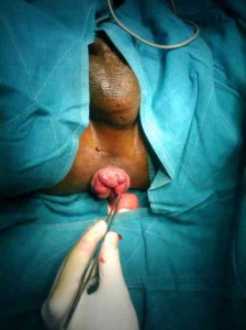 hemorrhoids 224x300 hemorrhoids