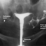 Hysterosalpingography : Procedure and Video