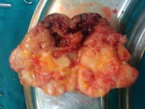parotid cancer 300x225 parotid cancer