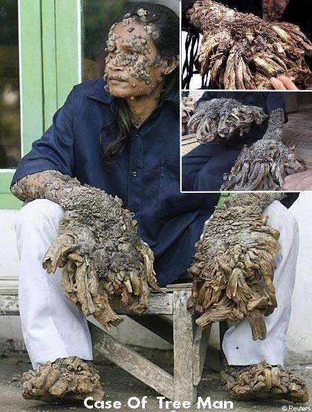 tree man before and after. girlfriend tree man after surgery. tree man after surgery. tree man after