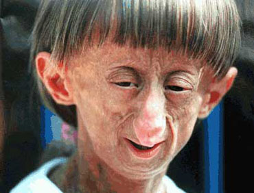 Progeria : Aging starts in Childhood | Medchrome