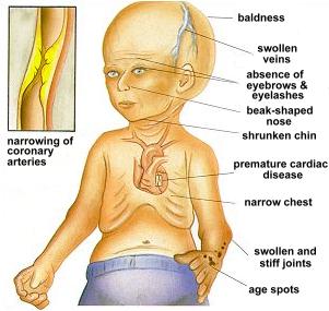 symptoms of progeria