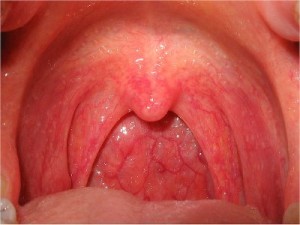 pharyngitis tonsillitis