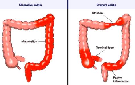 Crohn's disease vs UC