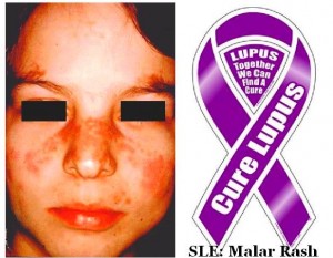 butterfly rash malar rash in lupus