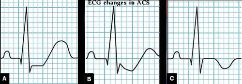 ECG changes in ACS