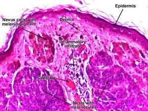 Intradermal Nevus Histology