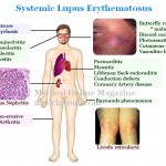 Symptoms Of Sle