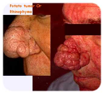 Rhinophyma Or Potato Tumor: A disfiguring tumor