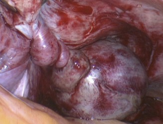 Complications Of Ovarian Cyst