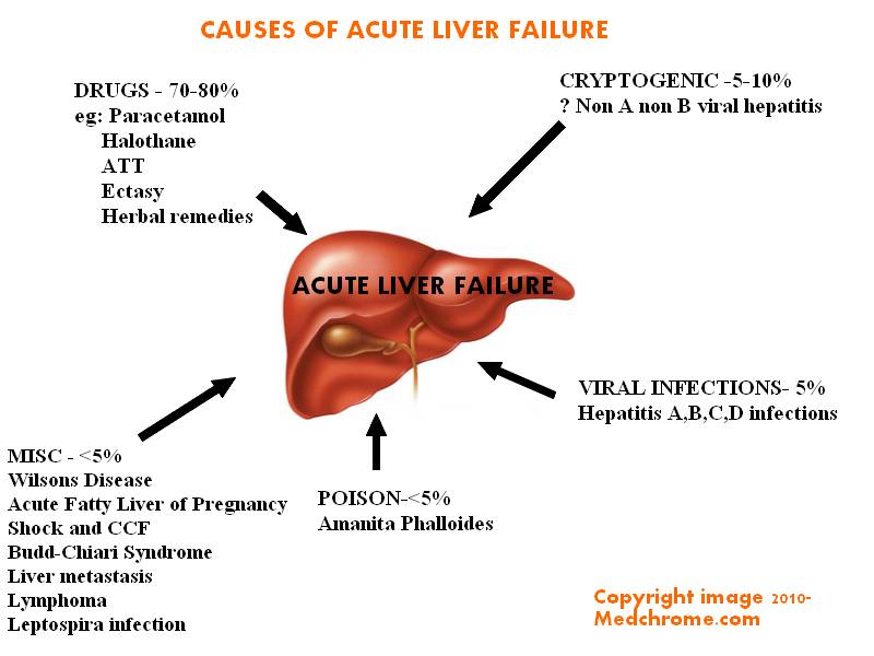 Acute Liver failure: Classification, causes, features and management