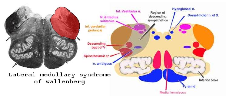 Lateral Medullary Syndrome : Wallenberg Syndrome