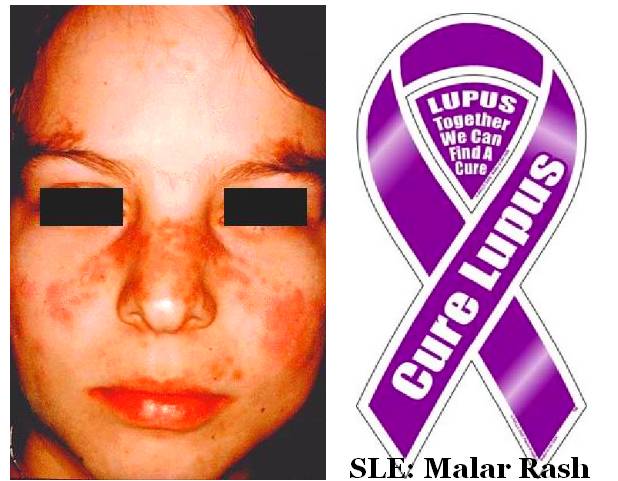 Systemic Lupus Erythematosus: ACR Criteria Diagnosis
