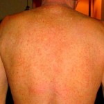 skin rash due to chloramine