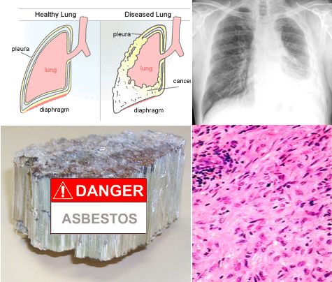 Detecting Mesothelioma – Asbestos related cancer