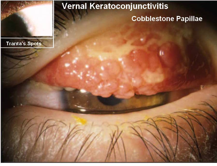 Vernal Keratoconjunctivitis – VKC or Spring Catarrah