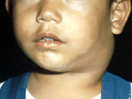 A case of Child with Fever, lymphadenopathy and Hepatosplenomegaly
