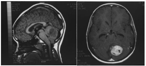 Case of child with Brain tumor – Medulloblastoma