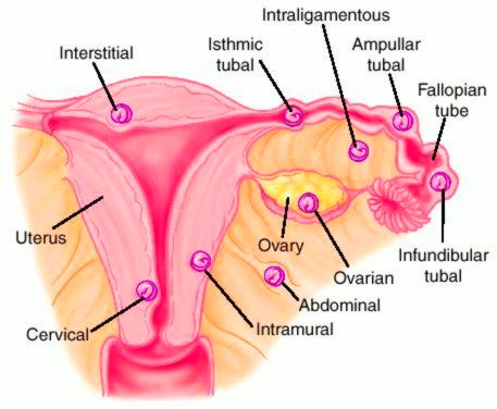 A Review of Ectopic Pregnancy