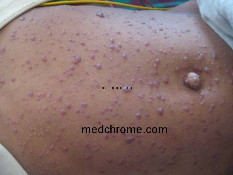 Chicken pox and its complications