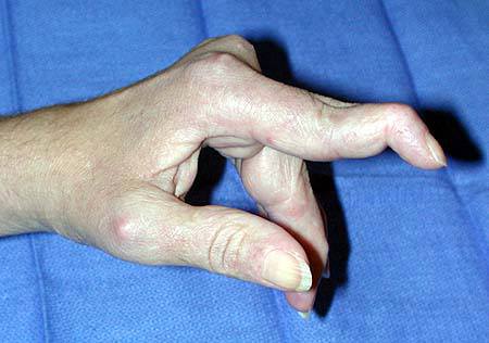 rhematoid arthritis