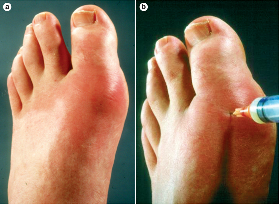 Gout: What it Is, How it’s Treated, and How to Prevent It