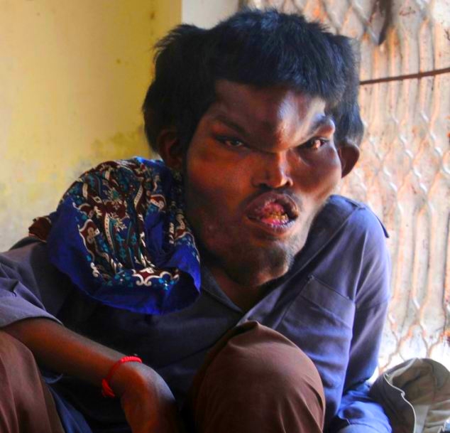 Proteus Syndrome or Giant Head: A Pakistani man’s Story