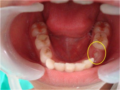permanent teeth inadequate space