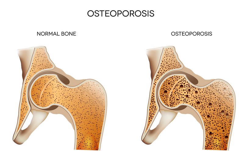 Osteoporosis bone vs normal bone