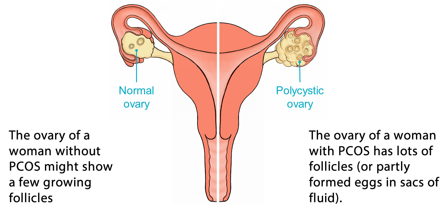 Abdominal and Ovarian Pain in Women