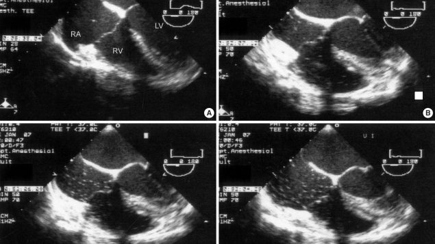 Fatal Air Embolism during URS surgery: A rare but known complication