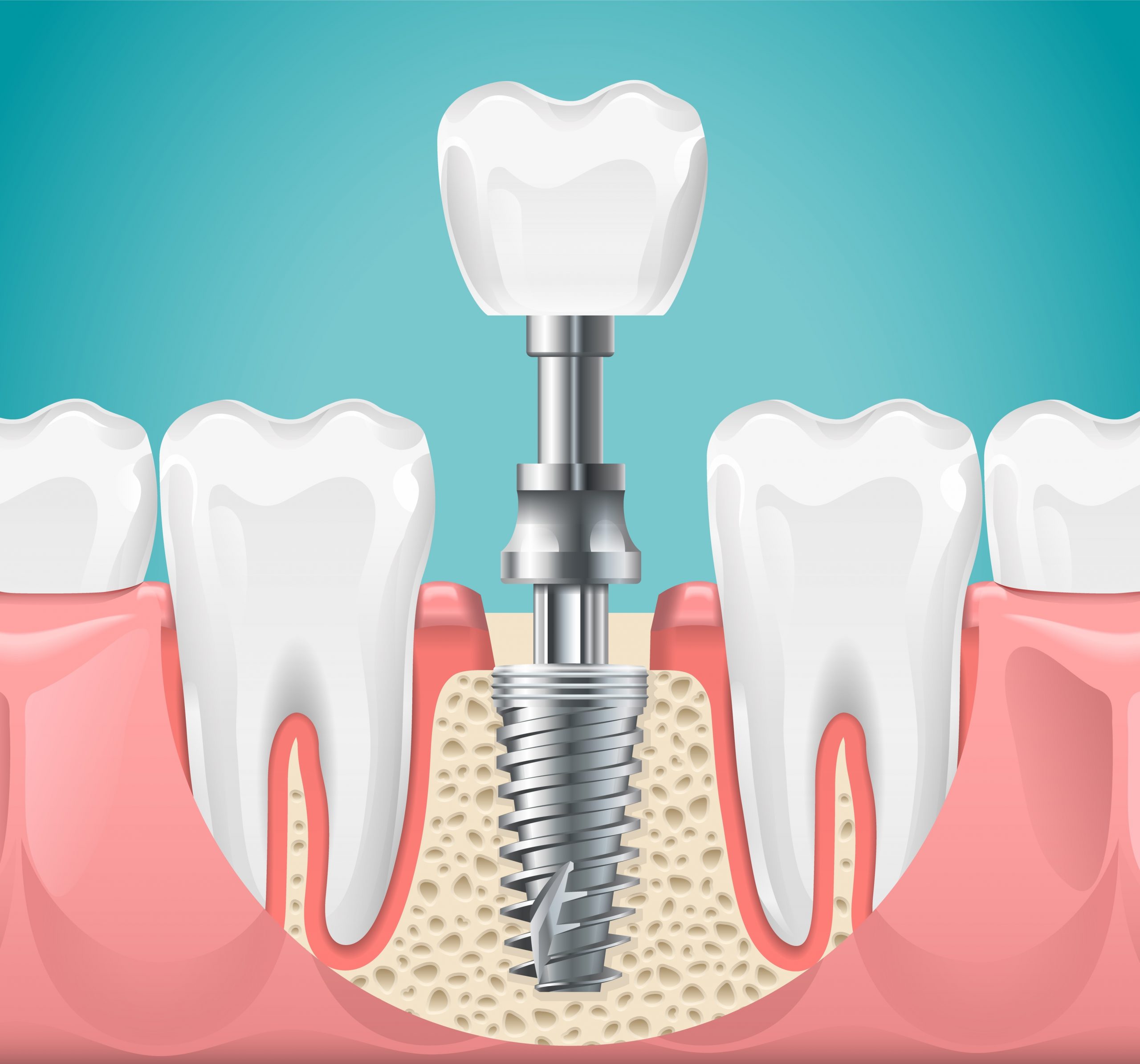 Dental Implants: 3 Types And How To Choose The Best