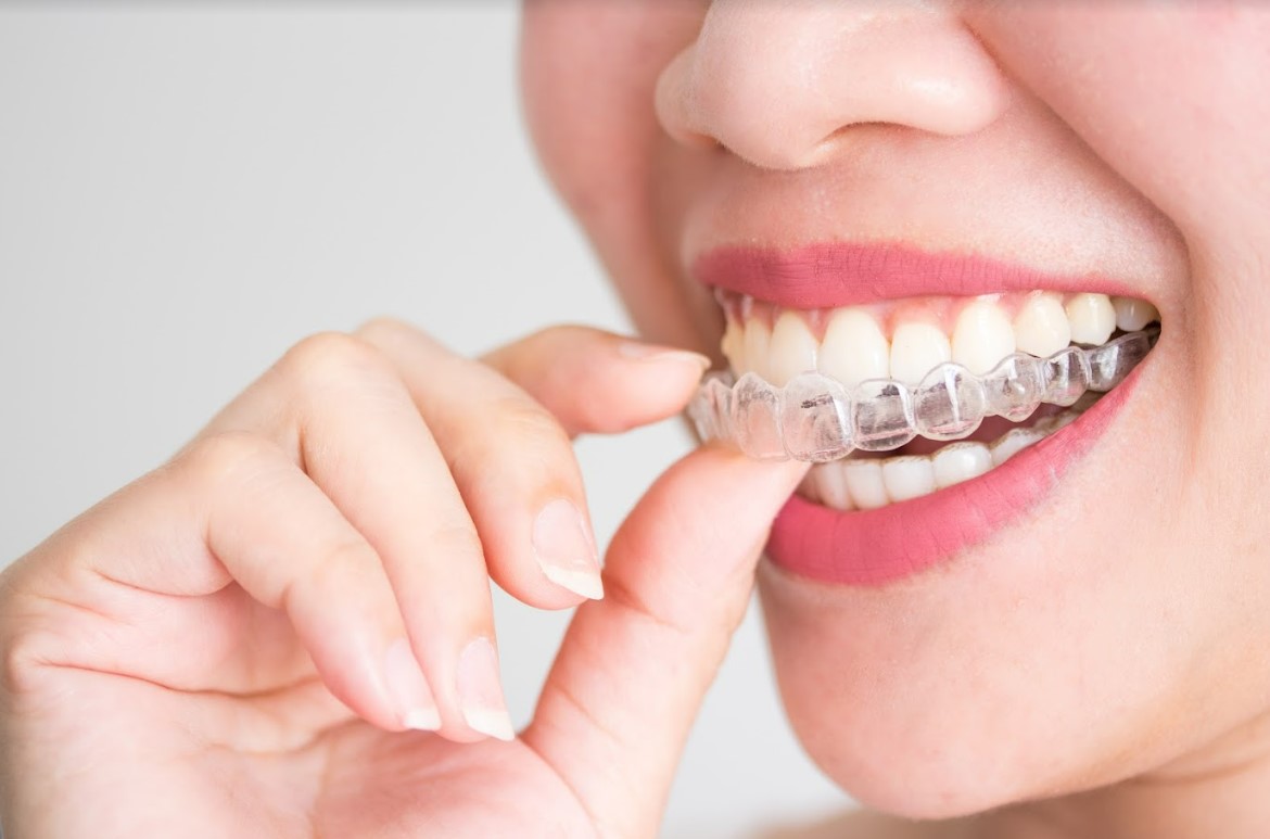 How To Know If You Need Invisalign