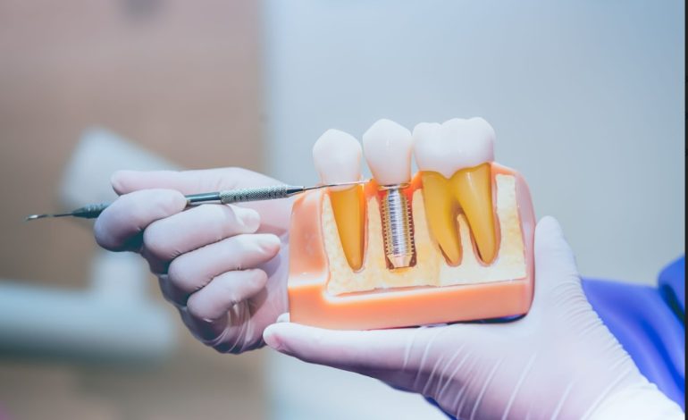 10 Things To Know Before Getting Dental Implants In Burlington