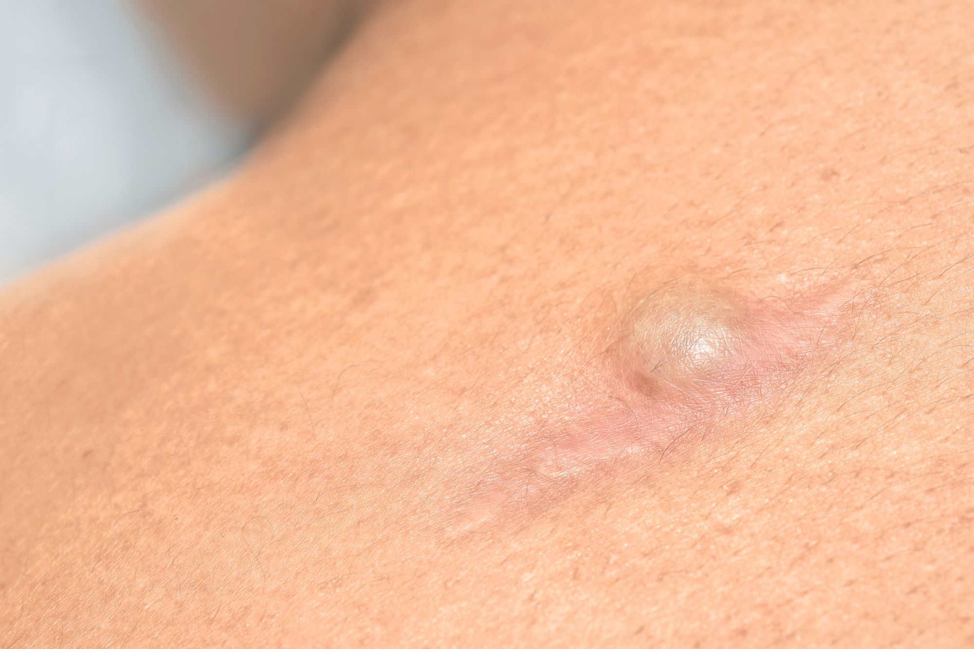 Epidermoid Cysts: Causes, Diagnosis, And Removal Solutions