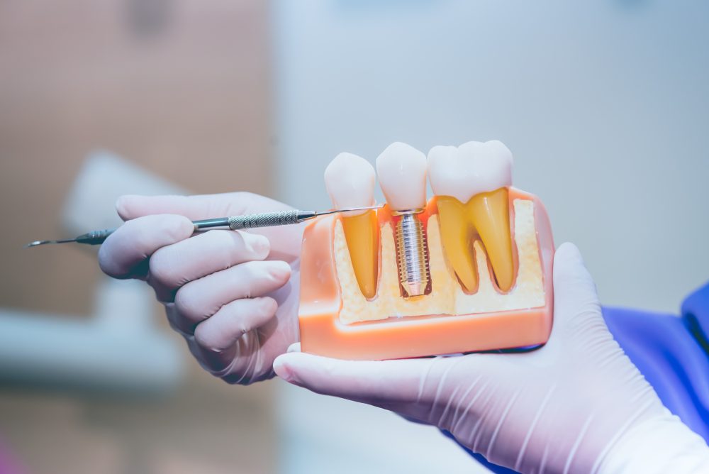 Maintaining Dental Implants: Tips For Longevity And Oral Hygiene