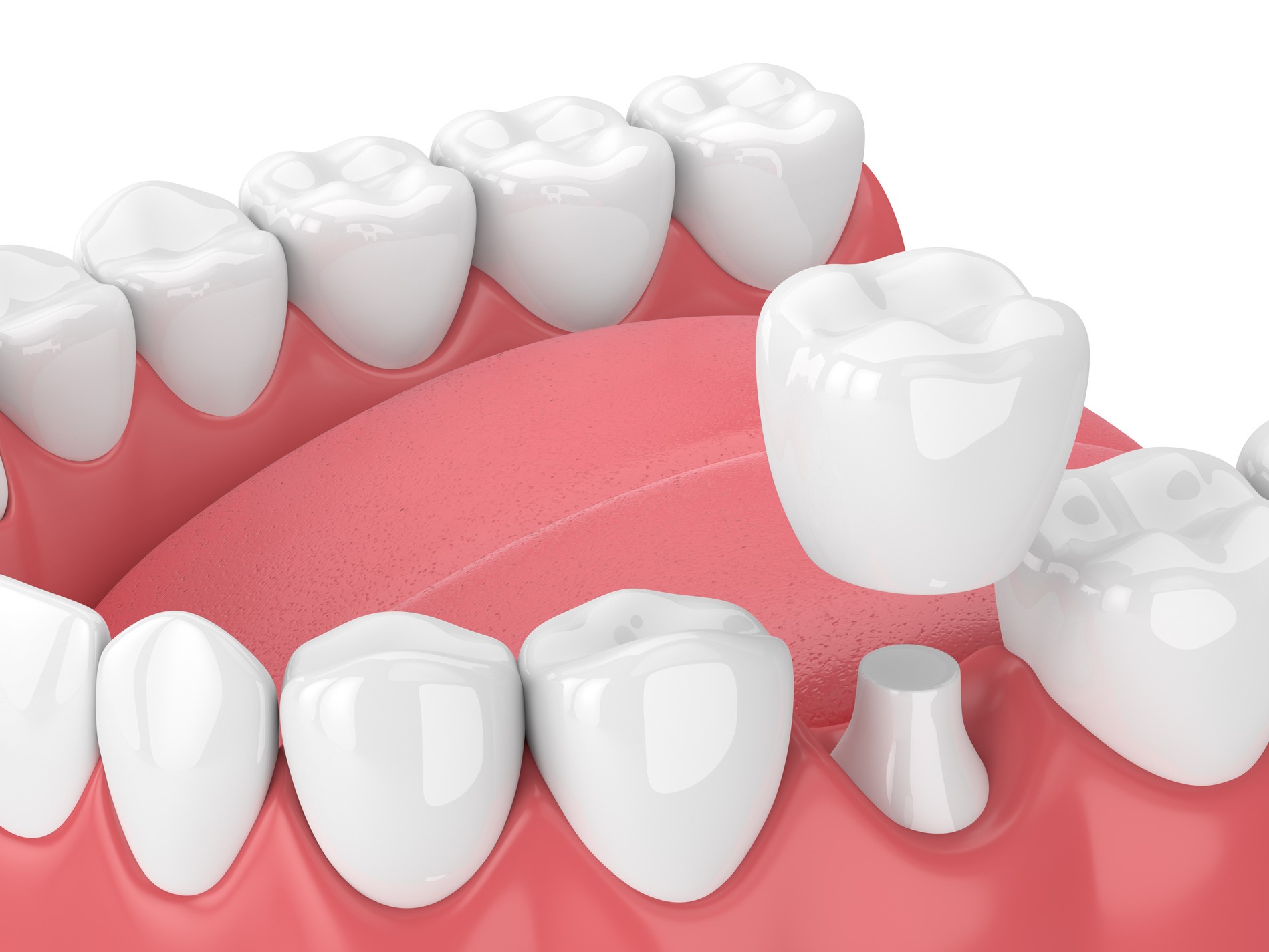 Understanding The Lifespan Of Porcelain Crowns