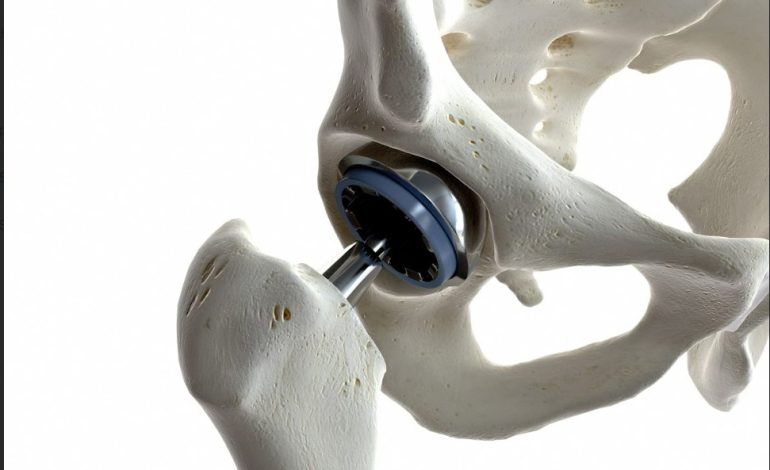 A Comprehensive Guide To Hip Replacement