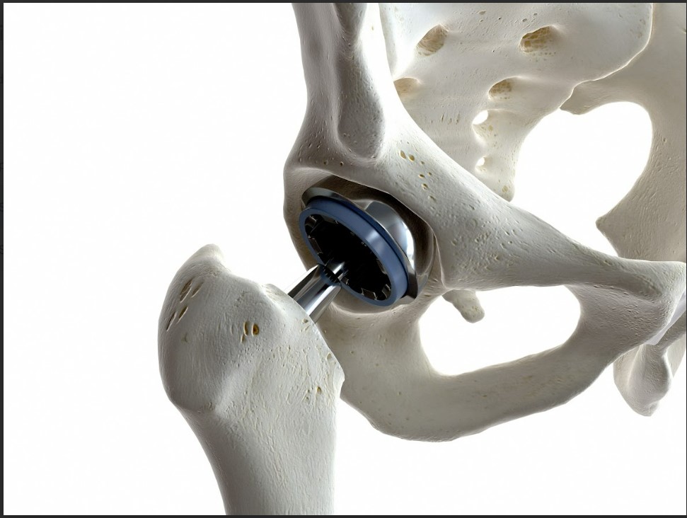 A Comprehensive Guide To Hip Replacement